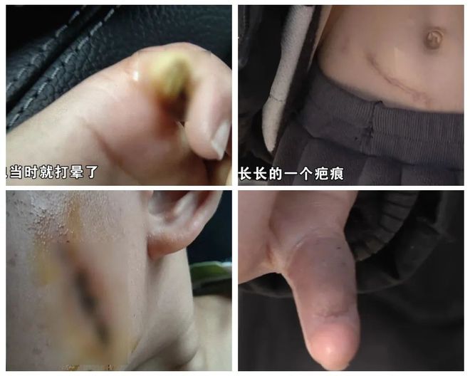 5岁儿童爬空调外机瞬间晕厥！凯发国际平台肌腱都打断了！(图8)